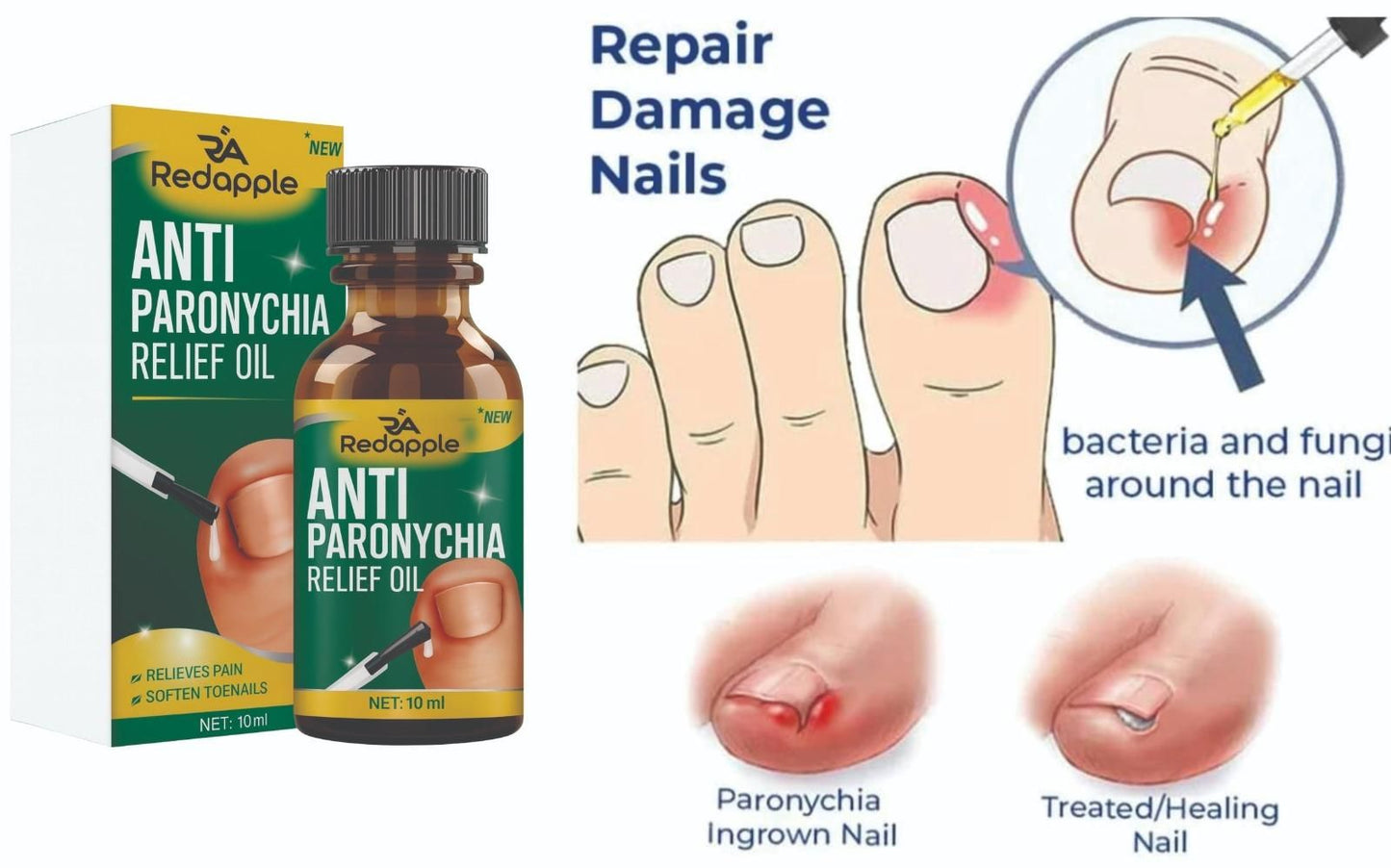 Anti Paronychia Relief Oil – Pack of 2 (20 ml Each)